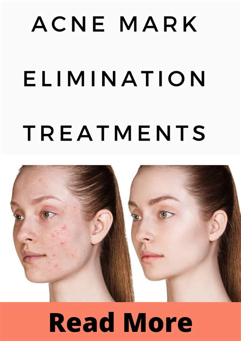 Acne Mark Elimination Treatments In 2020 Acne Marks Acne How To Get