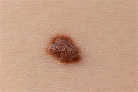 Mole Birthmark Nevus Macro Photo On Human Skin Close Up Stock Image