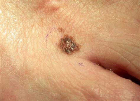 Pictures Melanoma Skin Cancer Moles