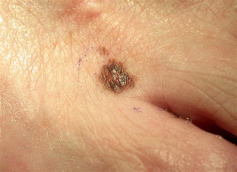 Moles Causes Types Abnormal Cancerous Moles