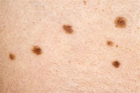 Basic Information About Skin Cancer Cdc