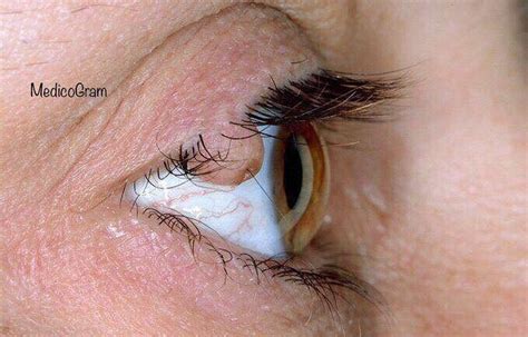 Eyelid Papilloma Medizzy