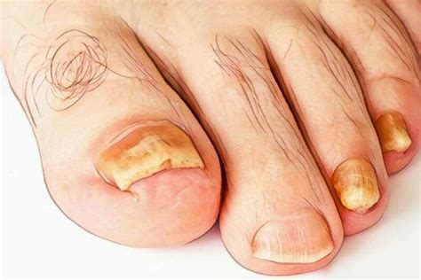 Thick Toenails Causes Treatment Pictures Trimming