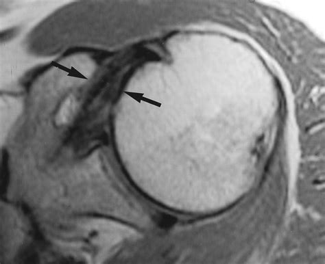 Coracohumeral Interval Imaging In Subcoracoid Impingement Syndrome On
