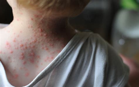 Two For One Chickenpox Vaccine Lowers Shingles Risk In Children