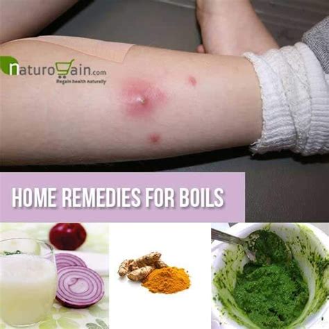 6 Diy Home Remedies For Boils Splendid Skin Care Tips Home Remedy