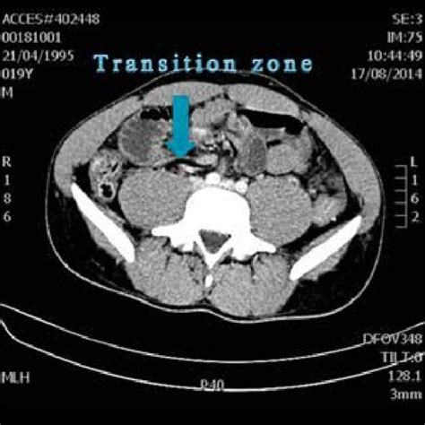 Transverse Cut Abdominal Pelvic Ct Of Case 3 Showing Transition Zone In