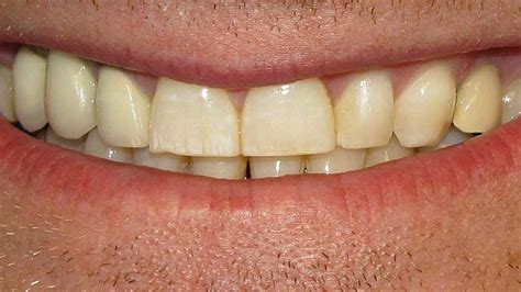 Are Yellow Teeth Healthy What Causes Yellow Teeth Doug Lewis Dentistry