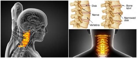 Cervical Spondylosis Causes Symptoms And Treatment Hoool Health Wellness