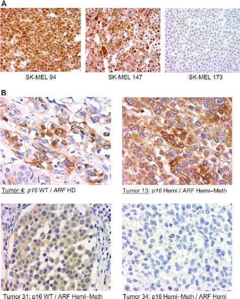 Immunohistochemistry Of P16 A Melanoma Cell Lines Tested For P16