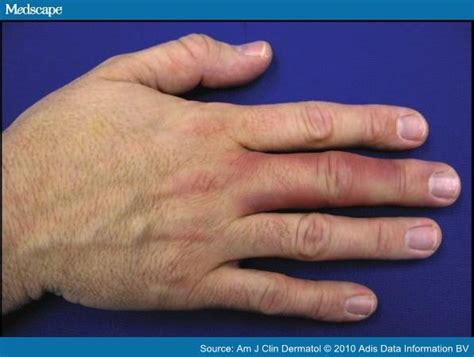 Is Achenbach Syndrome The Cause Of My Mysterious Purple Finger Empowher Womens Health Online