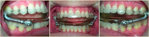 Sleep Apnea Treatment Vistancia Orthodontics