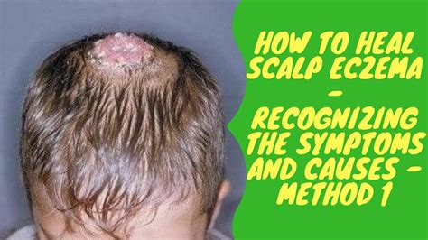 How To Heal Scalp Eczema Recognizing The Symptoms And Causes Method