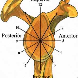 A torn labrum in the shoulder commonly occurs due to overuse or injury. Diagram showing extended SLAP tear classification according to... | Download Scientific Diagram