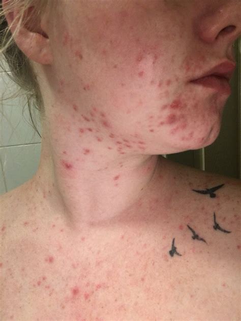 Cystic Acne On Chin During Second Trimester Help Netmums