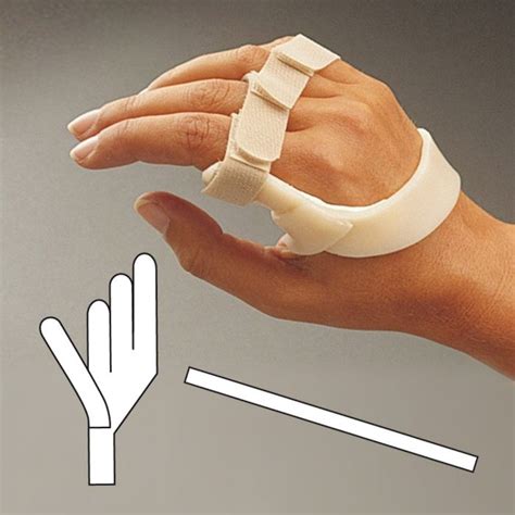 Alimed Long Ulnar Deviation Wrist Splint
