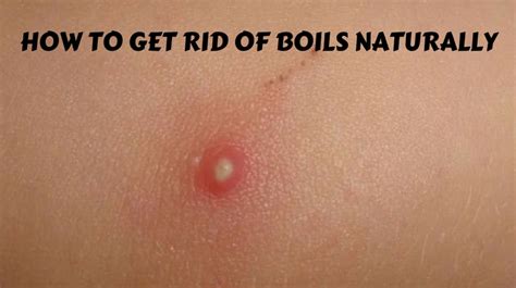 How To Get Rid Of Boils Naturally