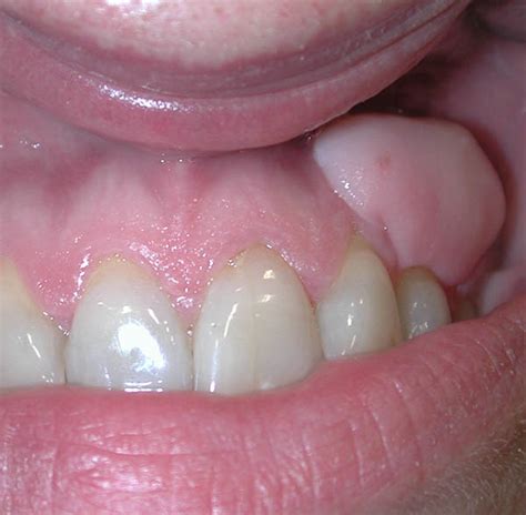 White Spots And Sores On Gums Causes Treatment And Symptoms Sexiz Pix