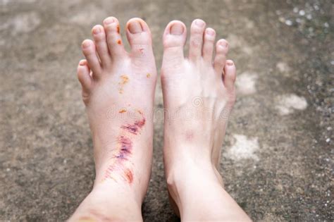 Bruise Wound On Woman`s Feet Stock Photo Image Of Blood Bleeding
