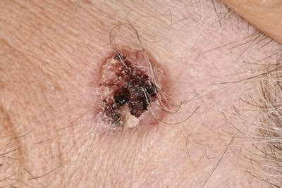Squamous And Basal Cell Carcinomas After Treatment Stock Image C040