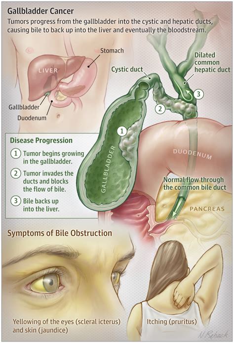 Blue, marigold, and purple awareness month: Gallbladder Cancer | Gastroenterology | JAMA | JAMA Network