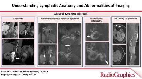 Understanding Lymphatic Anatomy And Abnormalities At Imaging