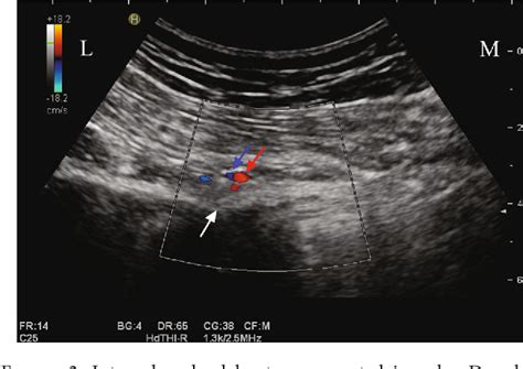 Figure 2 From Therapeutic Efficacy Of Ultrasound Guided High Voltage