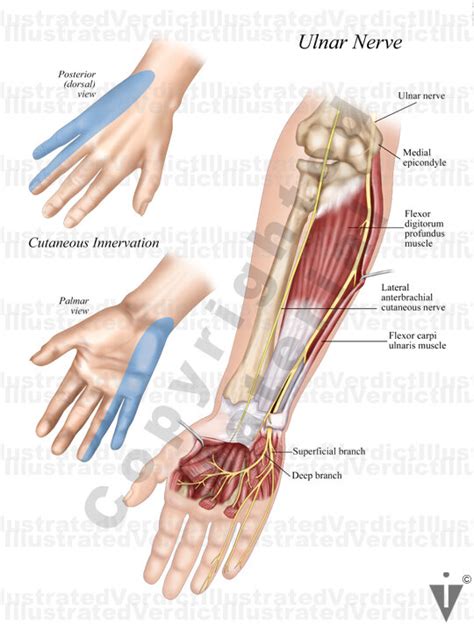 Stock Upper Limb Ulnar Nerve Transposition — Illustrated Verdict