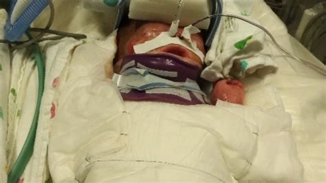 Texas Baby Jabari Gray Born Without Skin Opens Eyes For