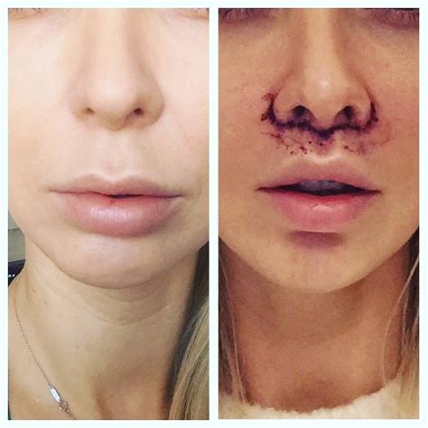 How much does lip lift surgery cost? Bullhorn lip lift at Dr. Osuch, Poland | Estheticon.com