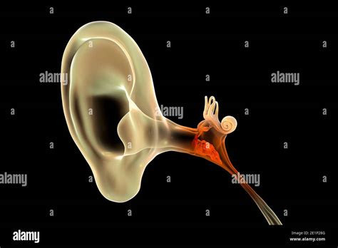 Otitis Media Infección Del Oído Ilustración Fotografía De Stock Alamy