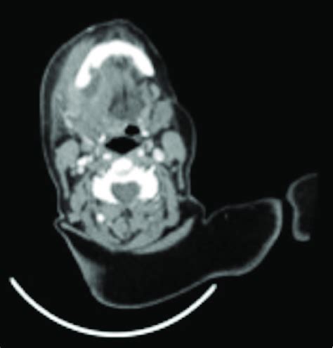 Axial View Of The Contrast Enhanced Ct Of The Neck Showing A Cystic