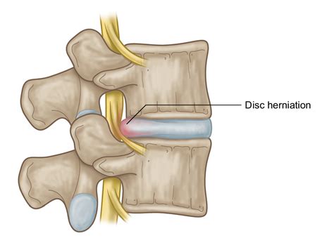 Intervertebral Discs In Yoga Managing Mechanical Forces — Stacy Dockins