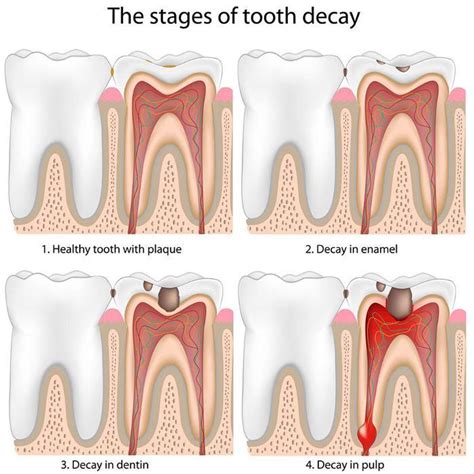 Dental Cavities In Orange Nsw Tooth Coloured Fillings