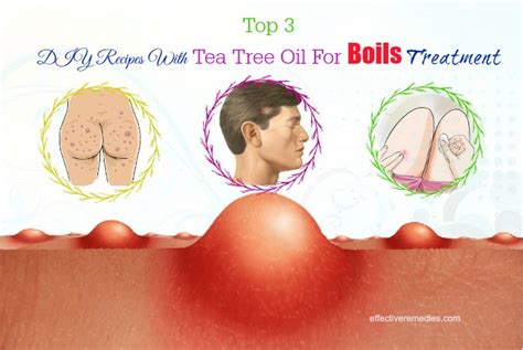 The Best Way To Use Tea Tree Oil For Boils On Scalp And Buttock