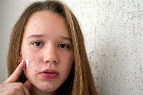 11 Tips For Clearing Teenage Acne