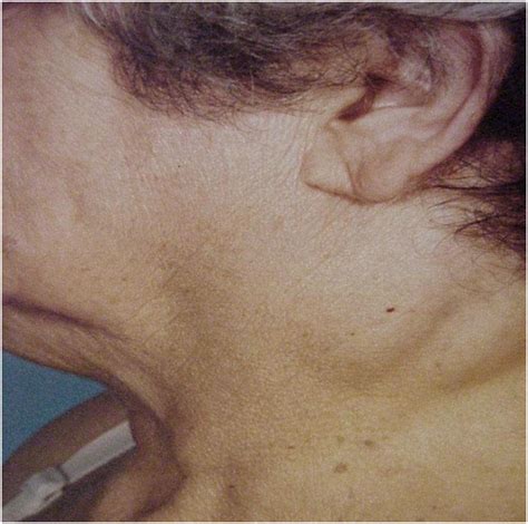 Optimal Imaging Of Infiltrating Lipomas Of The Neck Medcrave Online