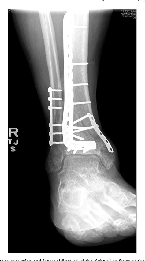 Figure 2 From The Medial Femoral Condyle Free Osteocutaneous Flap For