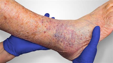 6 Things To Know When Treating Venous Leg Ulcers