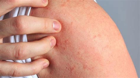 How Do You Get Scabies Causes Symptoms Treatment Pictures Riset