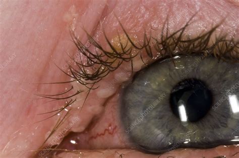 Herpes Simplex Lesions On Eyelid Stock Image C008 5728 Science Photo Library