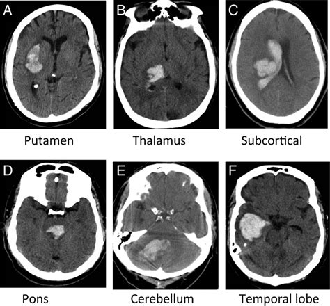 Current Management Of Spontaneous Intracerebral Haemorrhage Stroke
