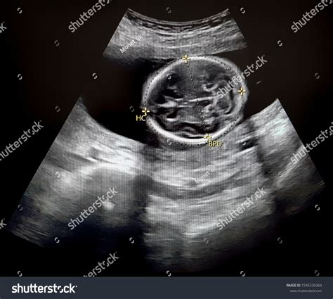 Ultrasound Fetal Head Circumference Stock Photo 1545230369 Shutterstock