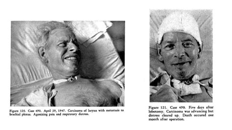 Lessons To Be Learnt From The History Of Lobotomy Tidsskrift For Den