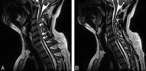 Blade In Sagittal T2 Weighted Mr Imaging Of The Cervical Spine