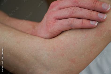 Dermatological Neurodermatitis On The Arm Of A Patient Stock Photo