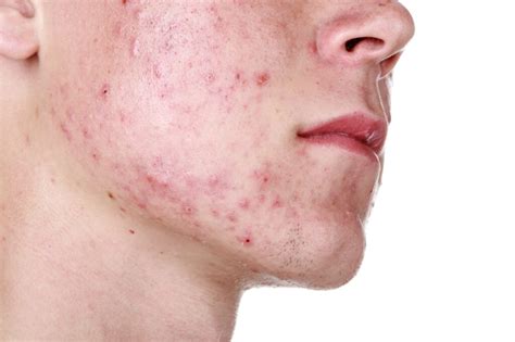Cystic Acne Treatments And Causes Explained By Top Dermatologists