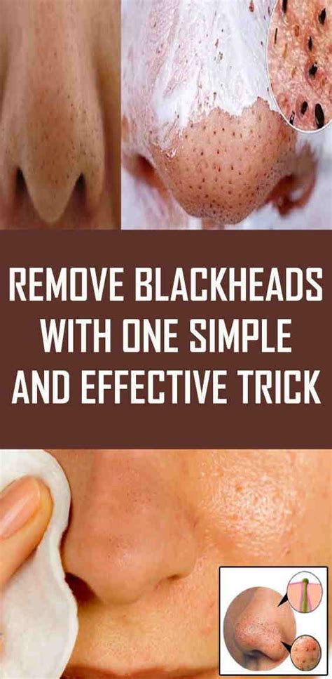 Remove Blackheads With One Simple And Effective Trick Fitness And