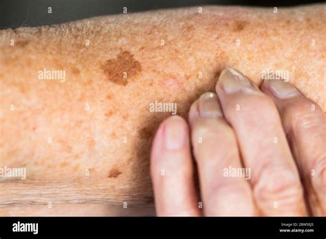 Sun Spots On Skin Hi Res Stock Photography And Images Alamy