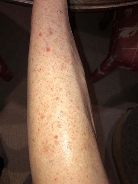 My Mom Woke Up With This Weird Rash On Her Legs Any Idea What It Could